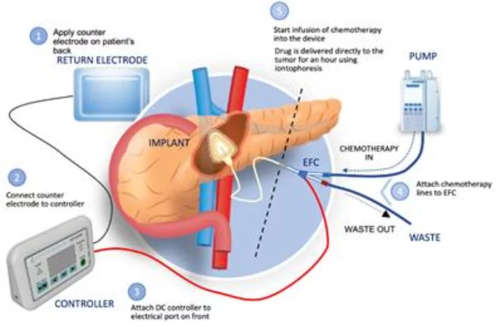 Focal Medical Complete Development of a Therapeutic System to Deliver Gemcitabine Directly to the Pancreas