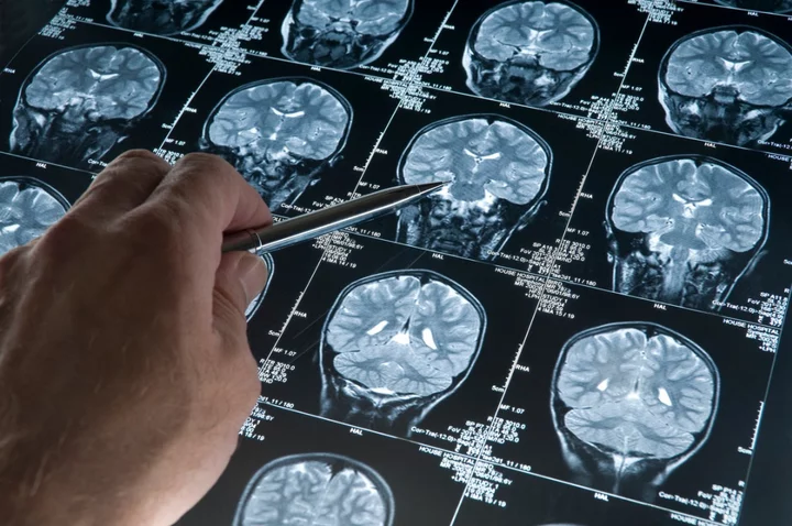 80-year-old Russian woman found to have lived her whole life with needle in brain