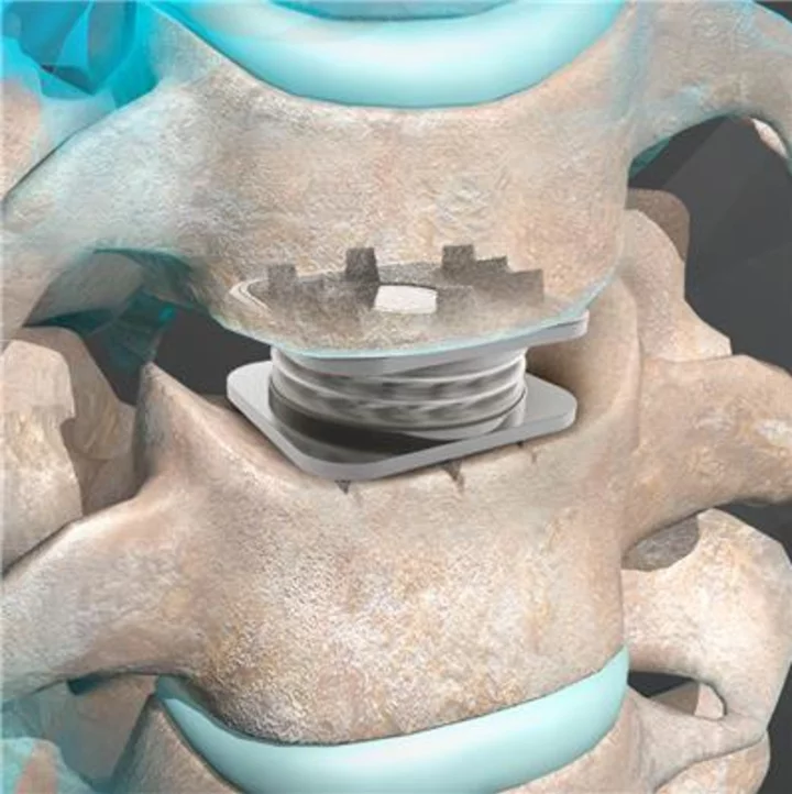 Orthofix Announces Publication in The Spine Journal of Five-Year Data for the M6-C Artificial Cervical Disc